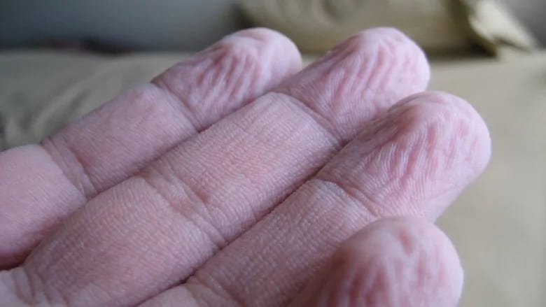 pruney fingers: why it is occuring, what is its Evolutionary Purpose????